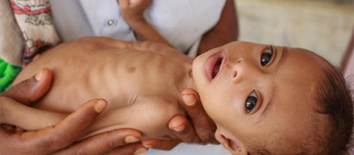 سوء تغذیه ۷۵ درصد از کودکان یمن